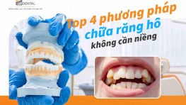 Top 4 phương pháp chữa răng hô không cần niềng