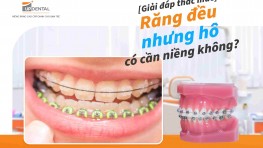 [Giải đáp] Răng đều nhưng hô có cần niềng không?