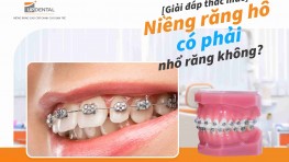 [Giải đáp] Niềng răng hô có phải nhổ răng không?