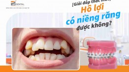 [Giải đáp] Hô lợi có niềng răng được không?