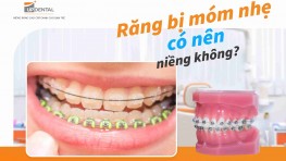 Răng bị móm nhẹ có nên niềng không?