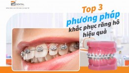 Top 3 phương pháp khắc phục răng hô hiệu quả