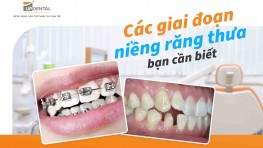 Các giai đoạn niềng răng thưa bạn cần biết