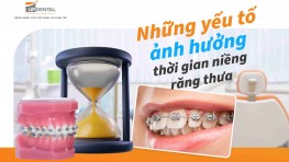 Thời gian niềng răng thưa mất bao lâu [Giải đáp]