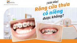 Răng cửa thưa có niềng được không? [Thắc mắc]