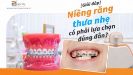 Niềng răng thưa nhẹ có được không? Các phương pháp niềng