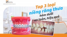 Top 3 phương pháp niềng răng thưa hàm dưới hiệu quả