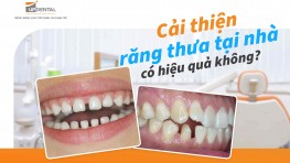 Cải thiện răng thưa tại nhà có hiệu quả không?