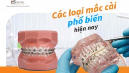 Các loại mắc cài niềng răng phổ biến hiện nay