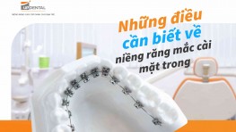 Niềng răng mắc cài mặt trong và những điều cần biết