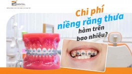 Chi phí niềng răng thưa hàm trên bao nhiêu?