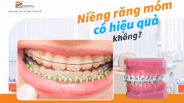 [Giải đáp thắc mắc] Niềng răng móm có hiệu quả không?