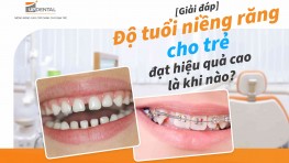 Độ tuổi niềng răng cho trẻ đạt hiệu quả cao là khi nào?