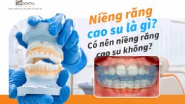 Niềng răng cao su là gì? Có nên niềng răng cao su không?