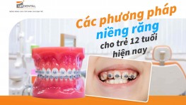 Niềng răng cho trẻ 12 tuổi có nên không? Các phương pháp