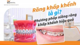 Răng khấp khểnh là gì? Phương pháp niềng răng khấp khểnh hiệu quả