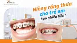 Niềng răng thưa cho trẻ em bao nhiêu tiền?