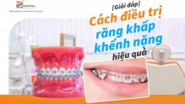 Cách điều trị răng khấp khểnh nặng hiệu quả [Giải đáp]