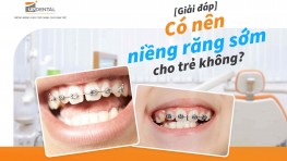 Có nên niềng răng sớm cho trẻ không? [Giải đáp]