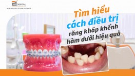 Tìm hiểu cách điều trị răng khấp khểnh hàm dưới hiệu quả 