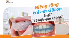 Niềng răng trẻ em silicon là gì? Có hiệu quả không?