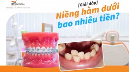 Giá niềng hàm dưới bao nhiêu tiền [09/2024] tại nha khoa Up Dental