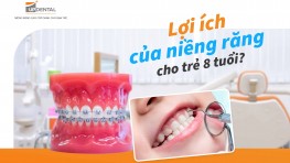 Niềng răng cho trẻ 8 tuổi và những thông tin cần biết