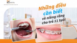 Niềng răng cho trẻ 11 tuổi và những thông tin cần biết