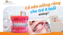 Niềng răng cho trẻ 9 tuổi không có nên không?