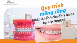 Quy trình niềng răng khấp khểnh chuẩn Y khoa tại Up Dental