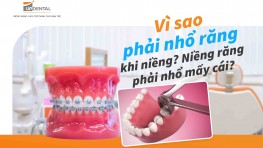 Vì sao phải nhổ răng khi niềng? Niềng răng phải nhổ mấy cái? 