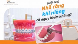 Giải đáp: Nhổ răng khi niềng có nguy hiểm không?
