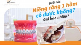 [Giải đáp] Niềng răng 1 hàm có được không? Giá bao nhiêu?