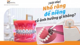 [Giải đáp] Nhổ răng để niềng có ảnh hưởng gì không?