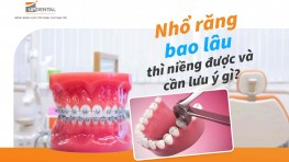 Nhổ răng bao lâu thì niềng được và cần lưu ý gì?