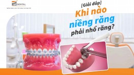 [Giải đáp] Khi nào niềng răng phải nhổ răng?