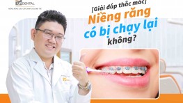 Giải đáp: Niềng răng có bị chạy lại không?