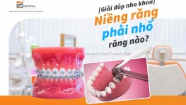 Giải đáp nha khoa: Niềng răng phải nhổ răng nào?