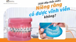 [Giải đáp] Niềng răng có được vĩnh viễn không?