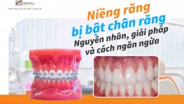 Niềng răng bị bật chân răng - Nguyên nhân, giải pháp và cách ngăn ngừa