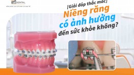 [Giải đáp] Niềng răng có ảnh hưởng đến sức khỏe không?