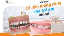 Giải đáp: Có nên niềng răng cho trẻ em không?