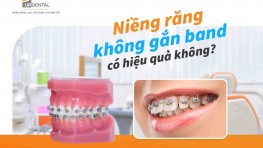 Niềng răng không gắn band có hiệu quả không?
