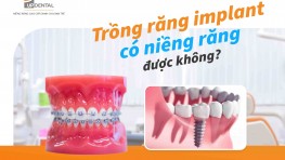 Trồng răng implant có niềng răng được không?