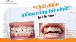 “Thời điểm niềng răng tốt nhất” là khi nào?