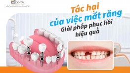 7 tác hại của việc mất răng - 4 giải pháp phục hồi hiệu quả