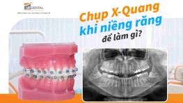  Chụp X-Quang khi niềng răng để làm gì?