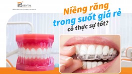 Niềng răng trong suốt giá rẻ có thực sự tốt?