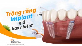 Trồng răng Implant giá bao nhiêu?