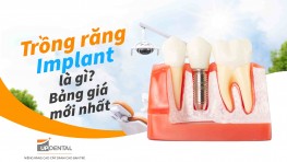 Trồng răng Implant là gì? Bảng giá trồng răng Implant mới nhất